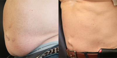 CoolSculpting before and after photo