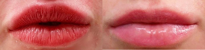 Dermal Fillers before and after photo