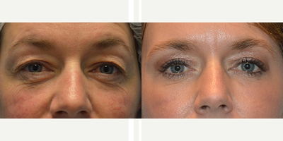 Eyelid Surgery before and after photo