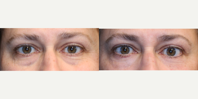 Eyelid Surgery before and after photo