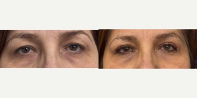 Eyelid Surgery before and after photo