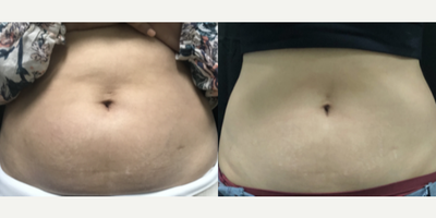 CoolSculpting before and after photo