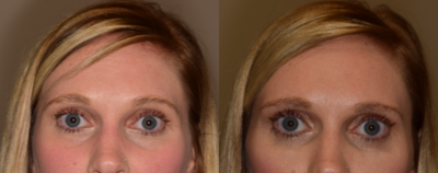 Dermal Fillers before and after photo