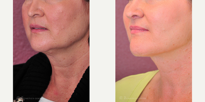 Facelift before and after photo