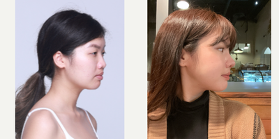 Cheekbone Reduction before and after photo