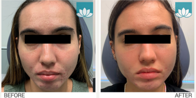 Chemical Peel before and after photo