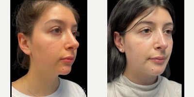 Chin Implant before and after photo