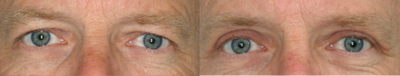Eyelid Surgery before and after photo