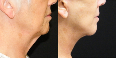 Facelift before and after photo