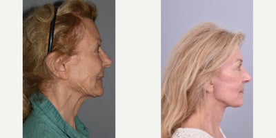 Facelift before and after photo