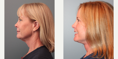 Mini Facelift before and after photo