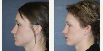 Rhinoplasty before and after photo
