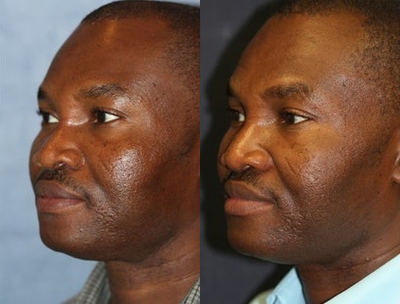 African American Rhinoplasty before and after photo
