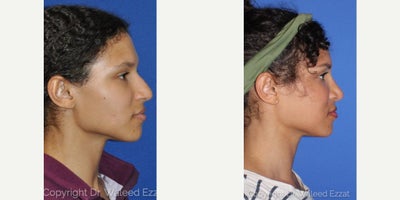 African American Rhinoplasty before and after photo