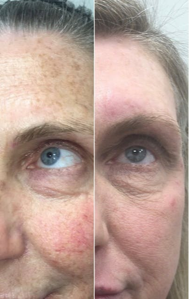 CO2 Laser before and after photo
