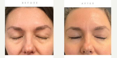 Eyelid Surgery before and after photo