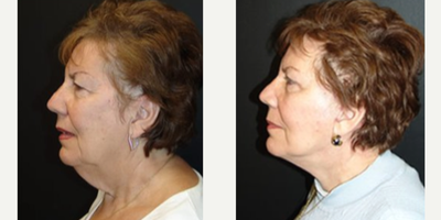 Facelift before and after photo