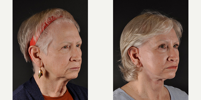 Facelift before and after photo