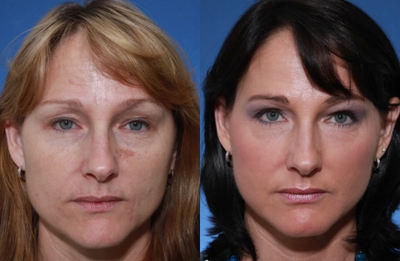 Facial Fat Transfer before and after photo
