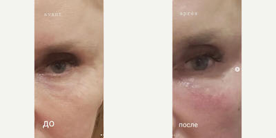 Facial Fat Transfer before and after photo