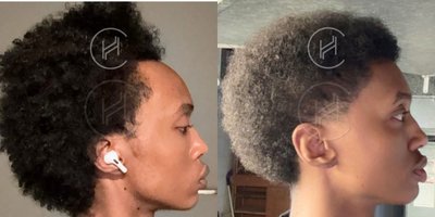FUE Hair Transplant before and after photo