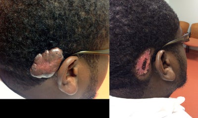 Scar Removal before and after photo