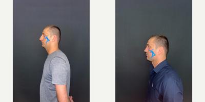 Chin Liposuction before and after photo