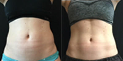 CoolSculpting before and after photo