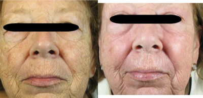 Fraxel Laser before and after photo