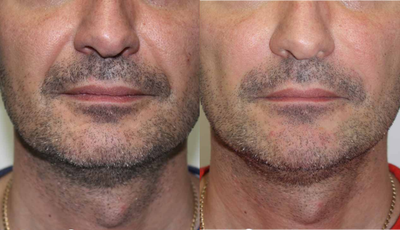 Juvederm before and after photo