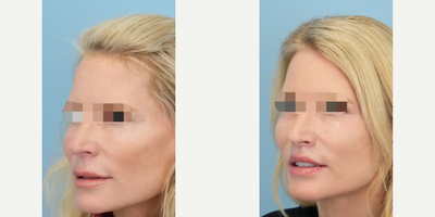 Lip Lift before and after photo