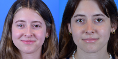 Septoplasty before and after photo