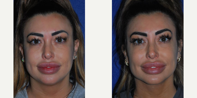 Buccal Fat Removal before and after photo
