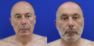 Facelift before and after photo
