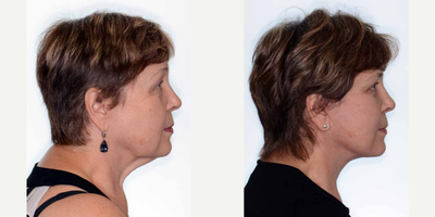 Facial before and after photo