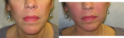 Juvederm before and after photo