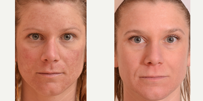 Laser Resurfacing before and after photo