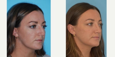 Septoplasty before and after photo