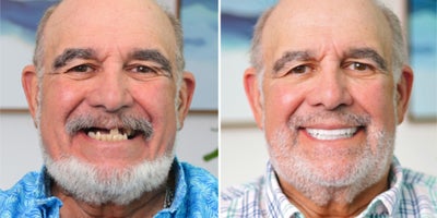 All-on-4 Dental Implants before and after photo