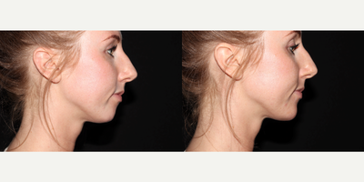 Chin Filler before and after photo