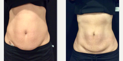 CoolSculpting before and after photo