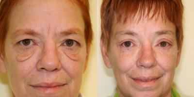Eyelid Surgery before and after photo