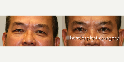Eyelid Surgery before and after photo