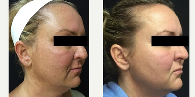 Laser Resurfacing before and after photo