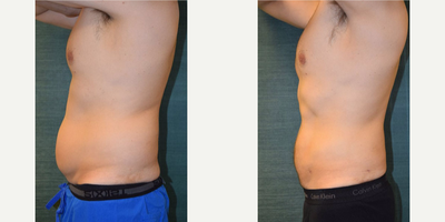 Liposuction before and after photo