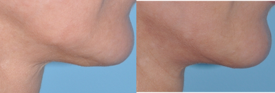 Mini Facelift before and after photo