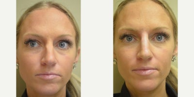 Nonsurgical Nose Job before and after photo