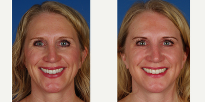 Restylane before and after photo