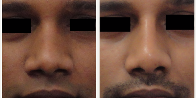 Rhinoplasty before and after photo