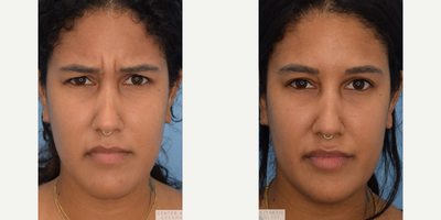 Botox before and after photo